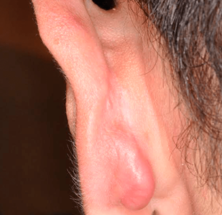 How to treat infected piercings