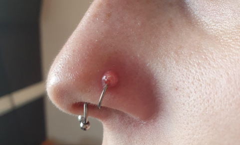 what does an infected nose piercing look like